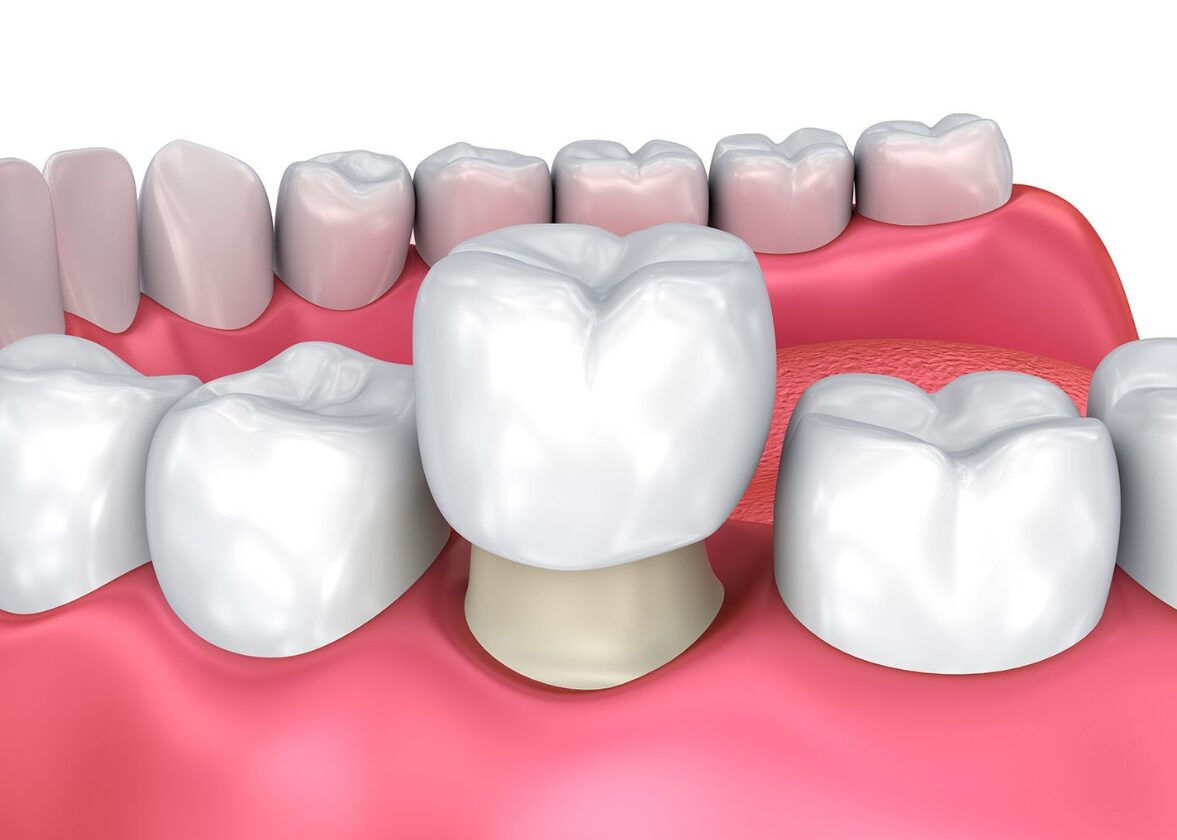 Bọc răng sứ cho trường hợp xiết lớn hoặc mất mô răng nhiều