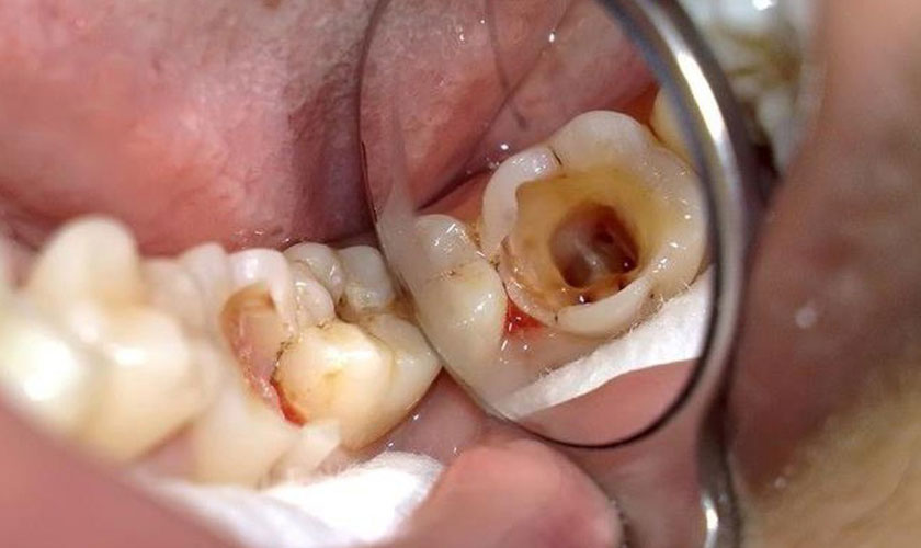 Giai đoạn 3: Xâm lấn đến tủy và cấu trúc nâng đỡ răng