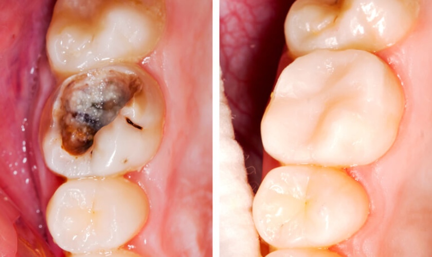 Giai đoạn 2: Xiết ăn răng tiến triển vào ngà răng