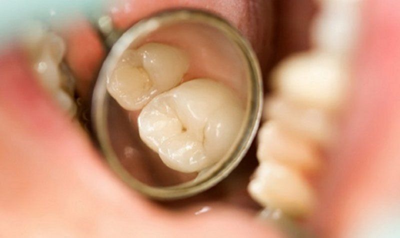 Giai đoạn 1: Sâu răng khởi phát, men răng tổn thương nhẹ
