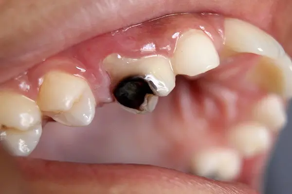 Dấu hiệu của bệnh xiết ăn răng trong nha khoa là gì?