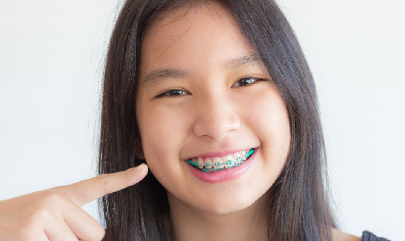 Phương pháp niềng răng và loại mắc cài được lựa chọn