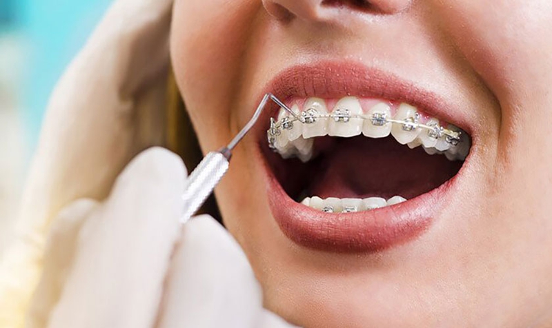 17 tuổi niềng răng bao nhiêu tiền?