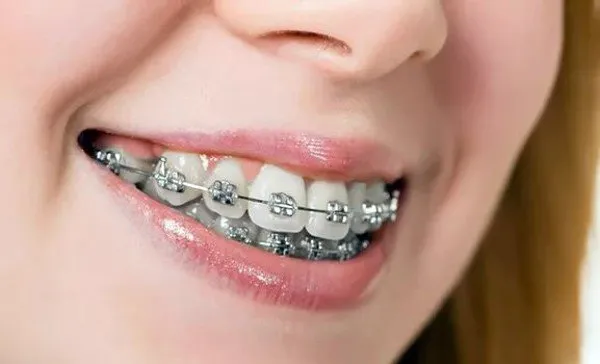 Niềng răng mắc cài kim loại