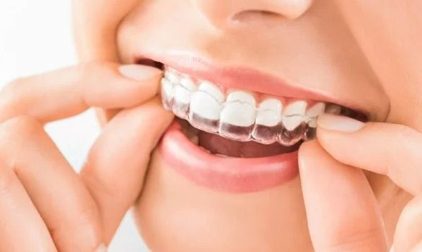 Niềng răng trong suốt