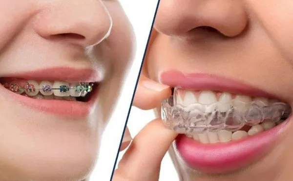 Loại khí cụ chỉnh nha được sử dụng để niềng