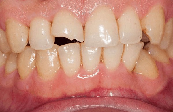 Tình trạng răng miệng hiện tại