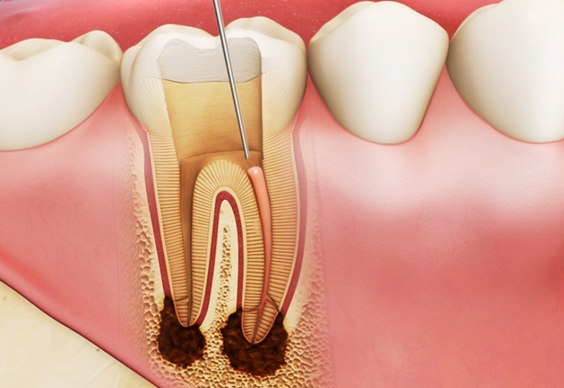 Viêm tủy răng ảnh hưởng đến phần lợi