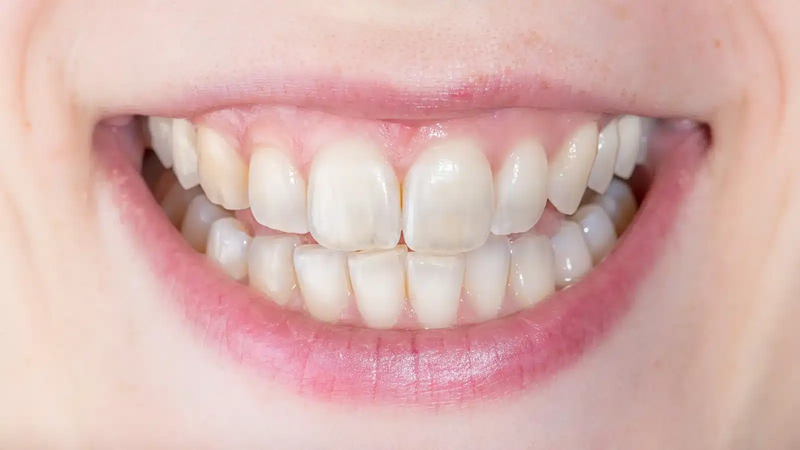 20 tuổi niềng răng có được không?