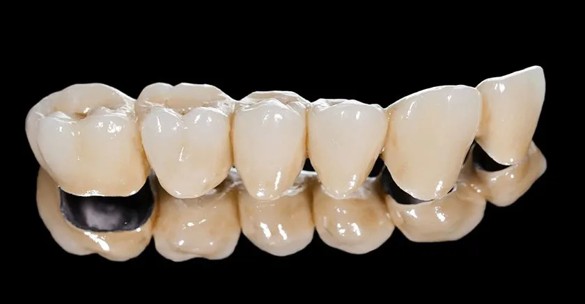 Ưu điểm nổi bật của bọc răng sứ bán phần