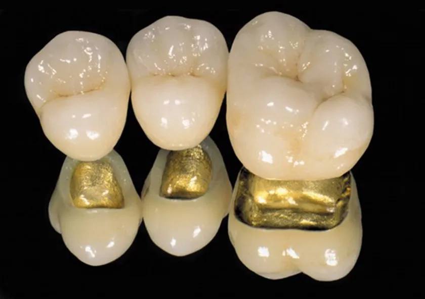 Bọc sứ bán phần kim loại quý