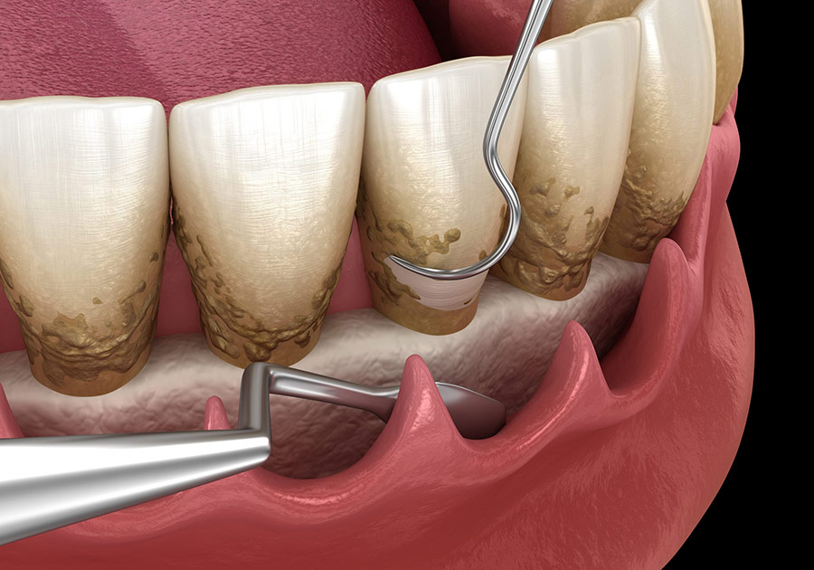 Cạo vôi răng giúp bà bầu giảm bị viêm lợi chảy máu chân răng