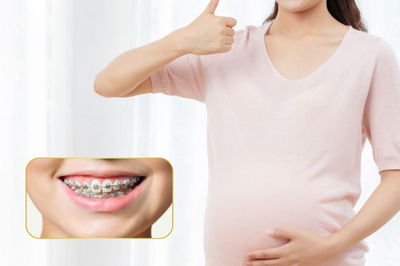 Lợi ích và rủi ro của việc niềng răng trong thai kỳ