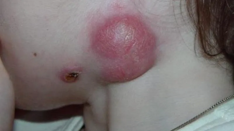 Nguy cơ viêm hạch, nhiễm trùng huyết