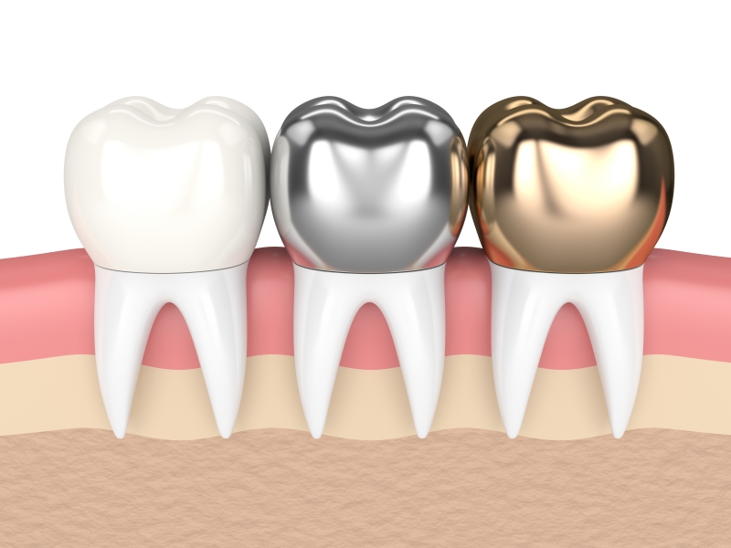 Nhược điểm cần lưu ý của răng sứ bán phần