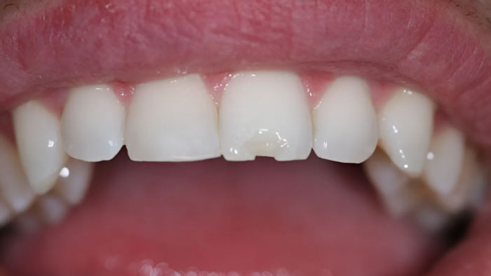 Răng sứ bị vỡ, nứt hoặc sứt mẻ