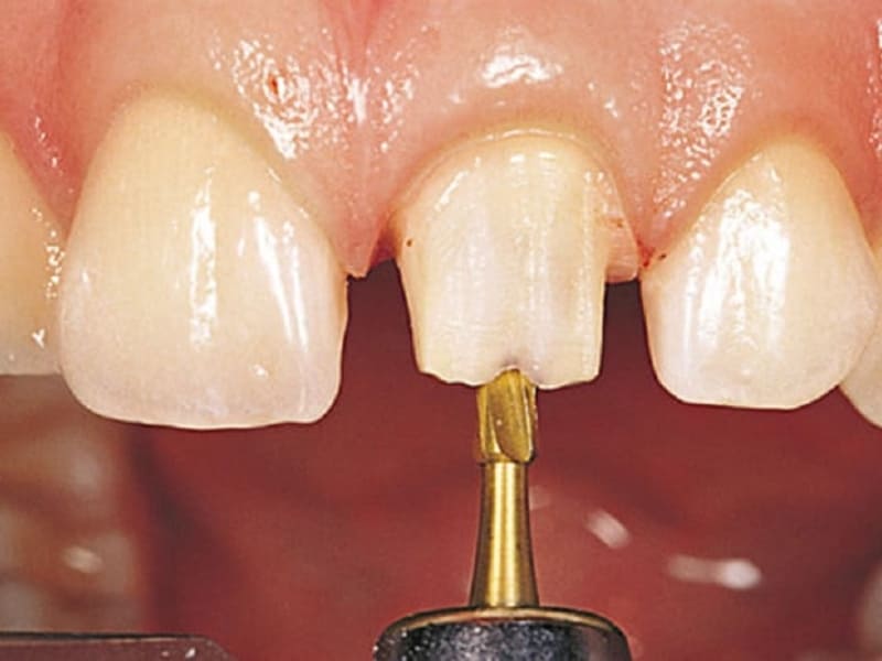 Bước 3: Chuẩn bị cùi răng và lấy dấu răng mới