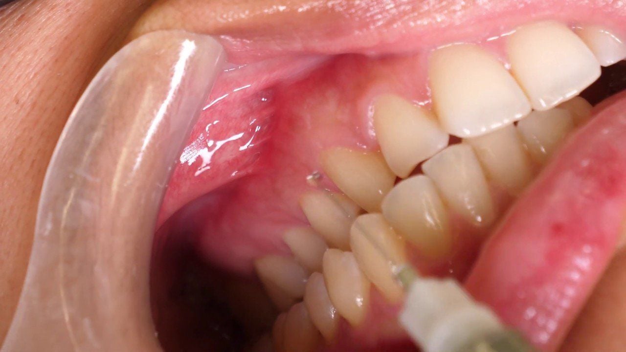 Bước 1: Vệ sinh khoang miệng và gây tê tại chỗ