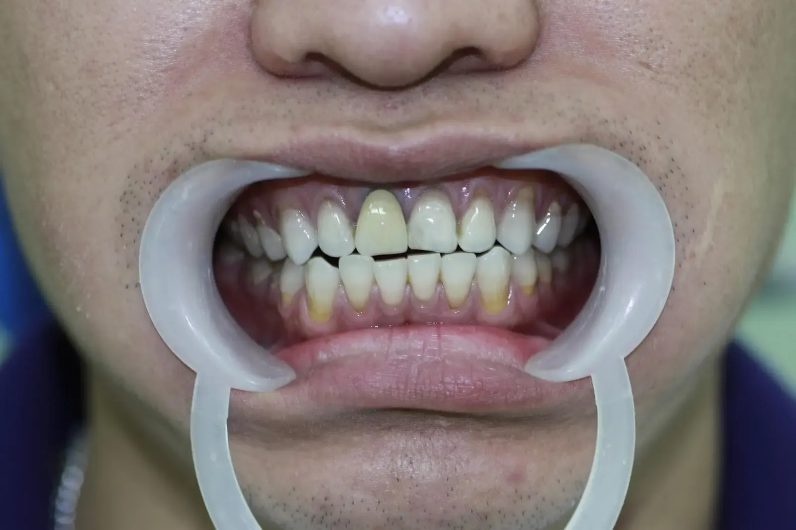 Đen viền nướu sau khi bọc răng sứ