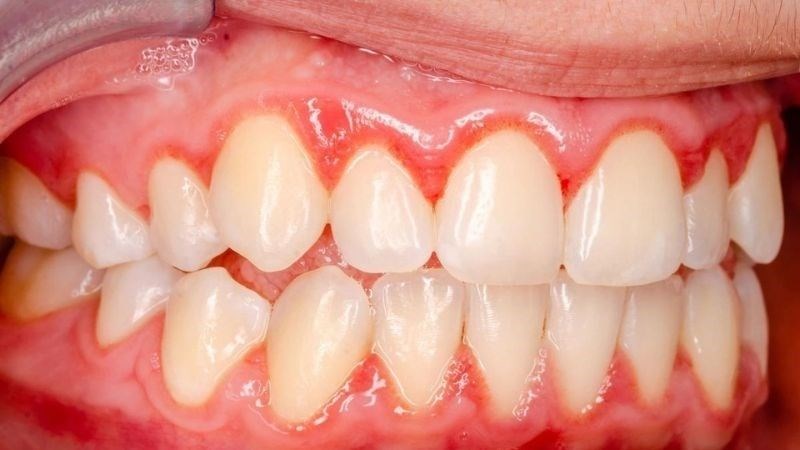 Những dấu hiệu viêm lợi thường gặp phổ biến nhất