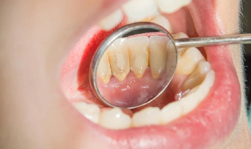 Làm sạch cấu trúc răng bị sâu