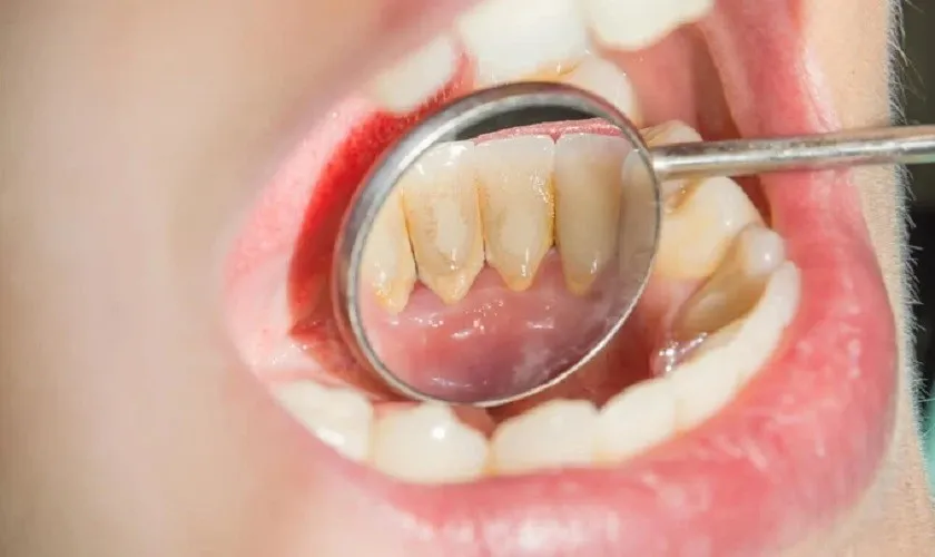 Làm sạch cấu trúc răng bị sâu