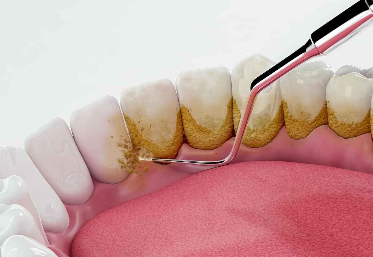 Cạo vôi răng và kiểm tra định kỳ sức khỏe răng miệng