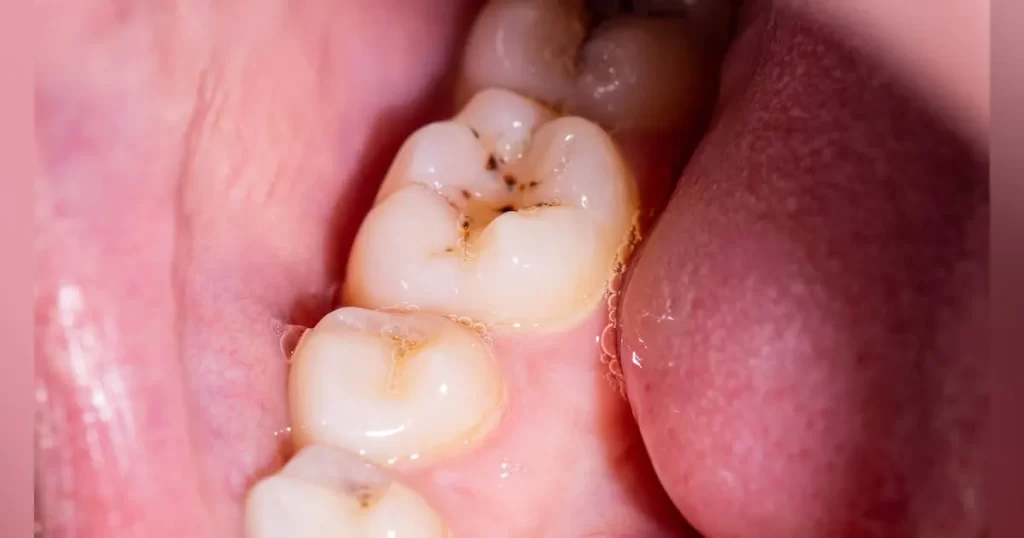 Lỗ sâu răng là gì?