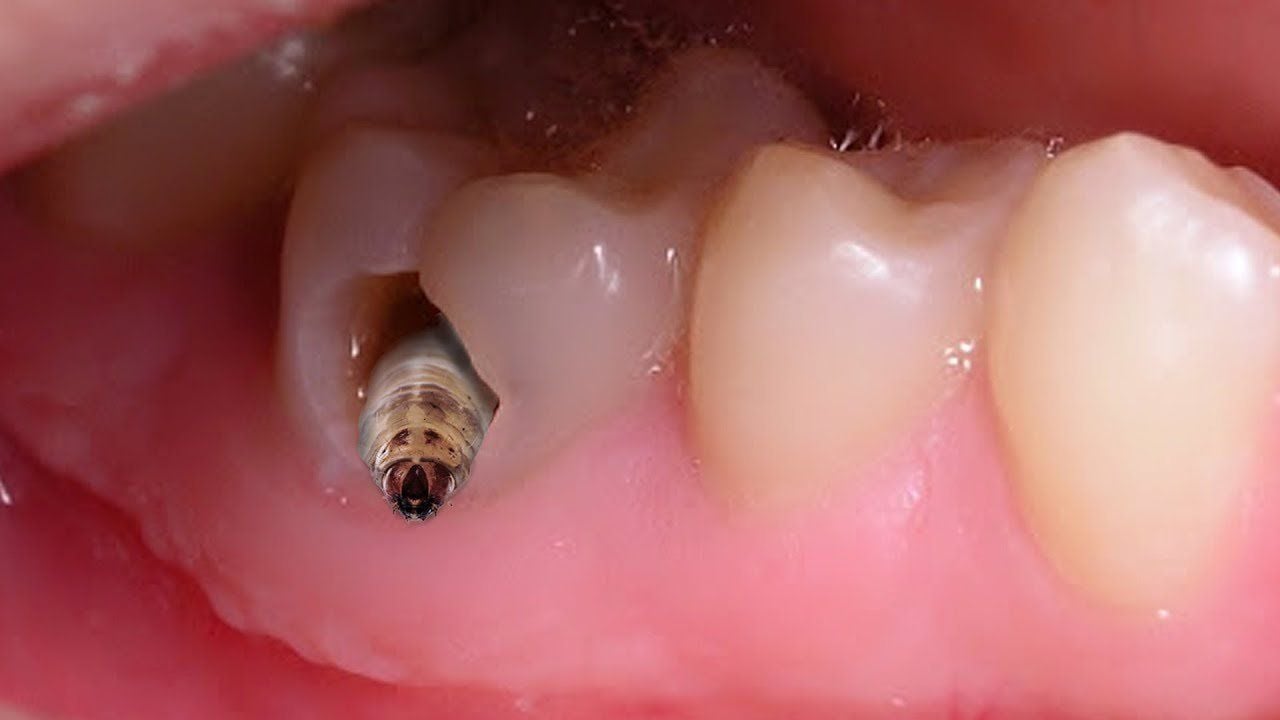 Nguy cơ nếu không xử lý kịp thời lỗ sâu răng