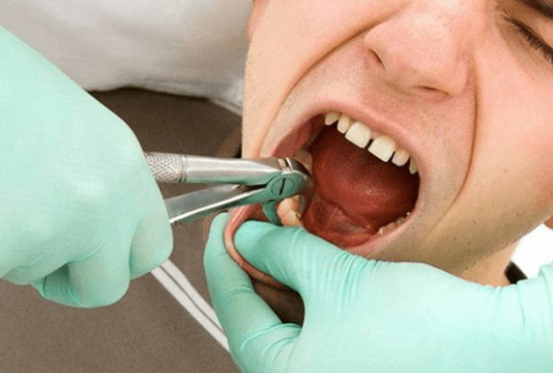 Vì sao nhổ răng bị chảy máu?