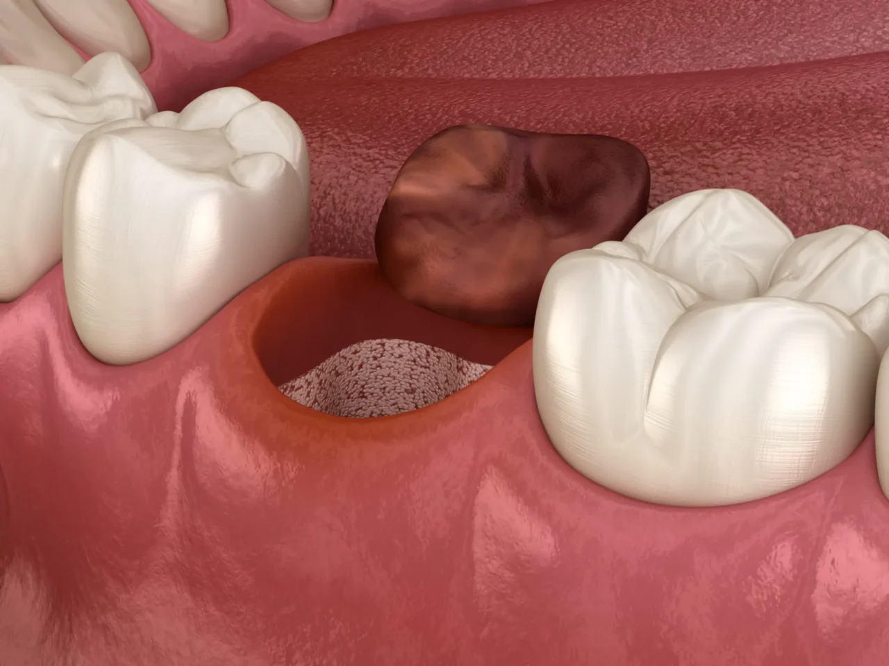 Tránh làm rối loạn cục máu đông