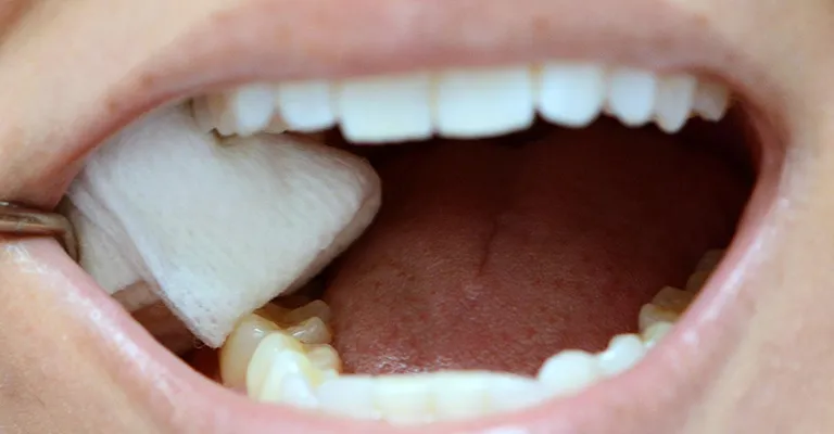 Cố định băng gạc và cầm máu sau khi nhổ răng