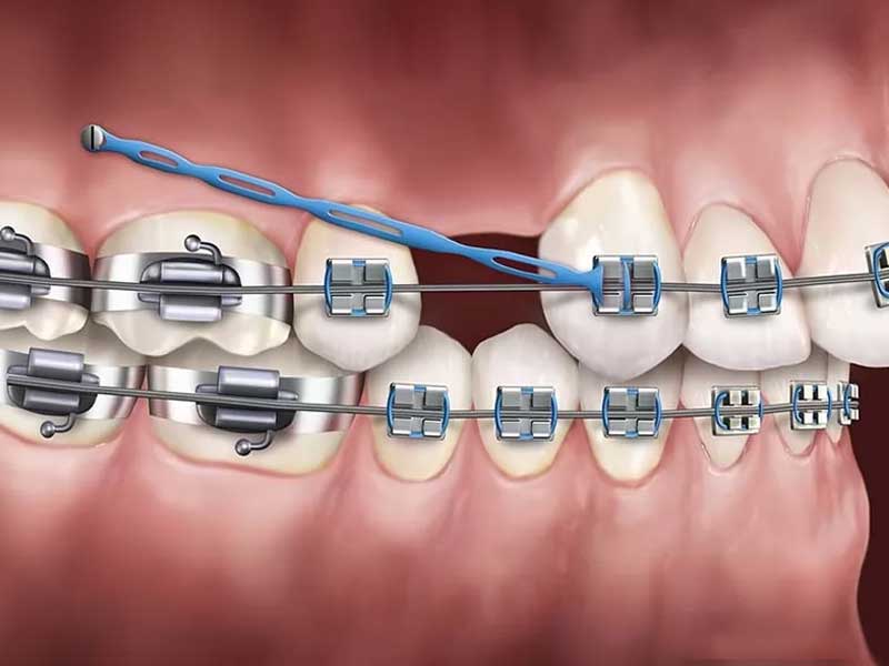 Cắm vít niềng răng bao lâu thì tháo được là an toàn nhất?