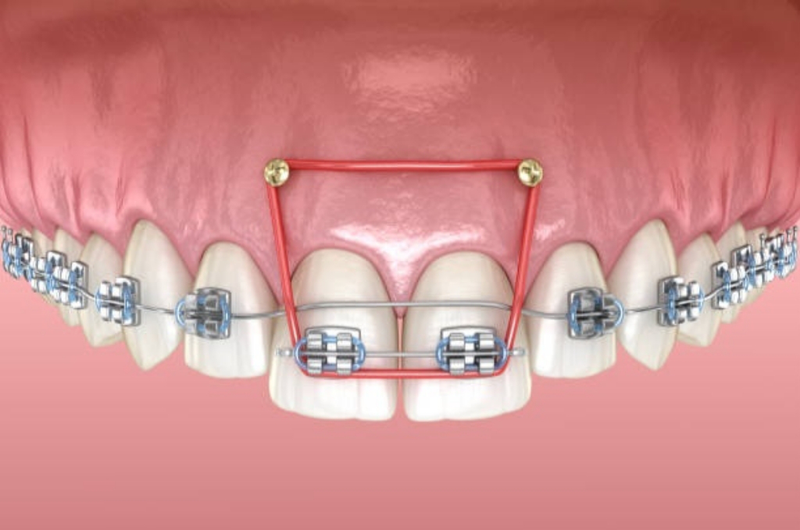 Tháo vít sau khi hoàn tất điều trị cần thiết