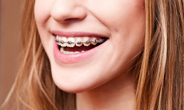 Công dụng của việc cắm vít niềng răng là gì?