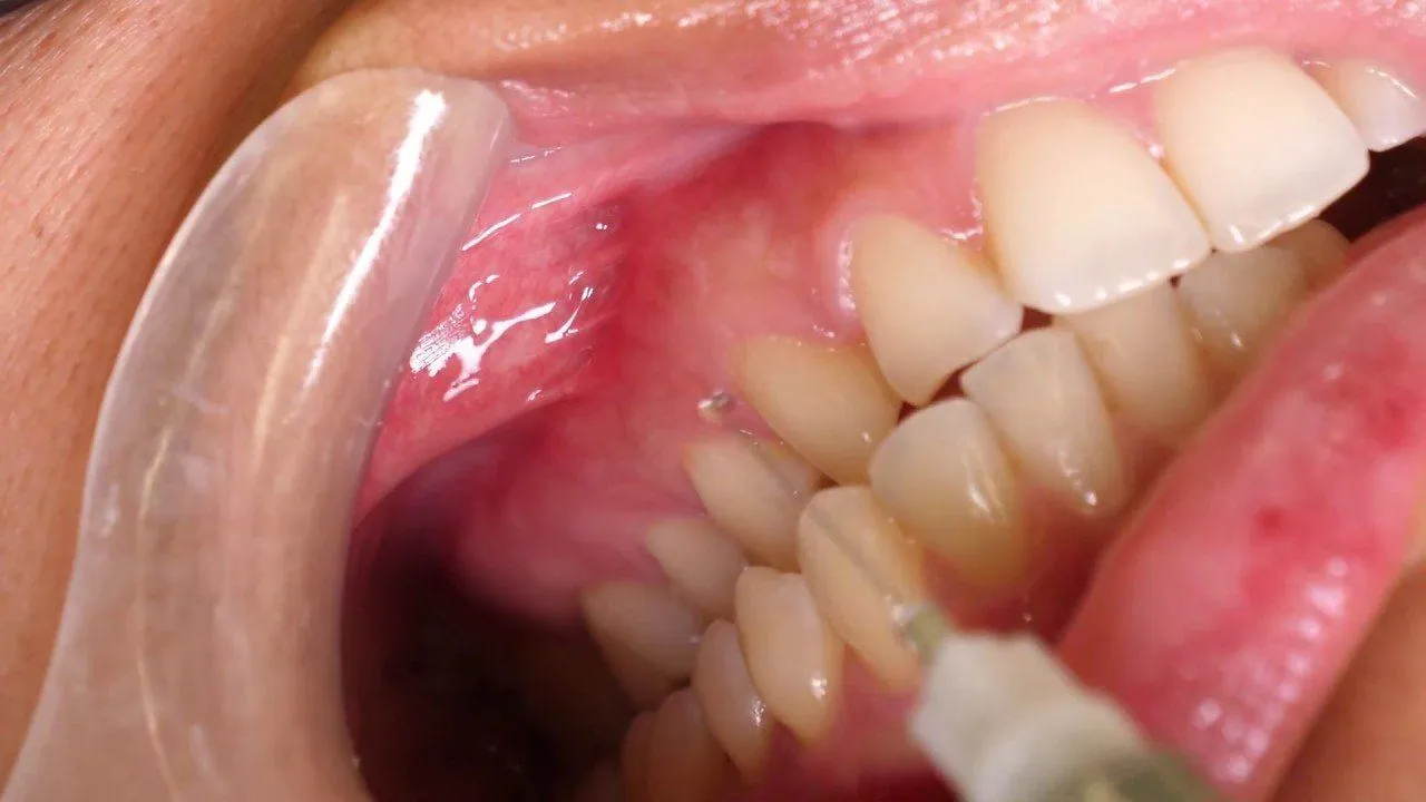 Gây tê – Đảm bảo sự thoải mái tuyệt đối cho bệnh nhân
