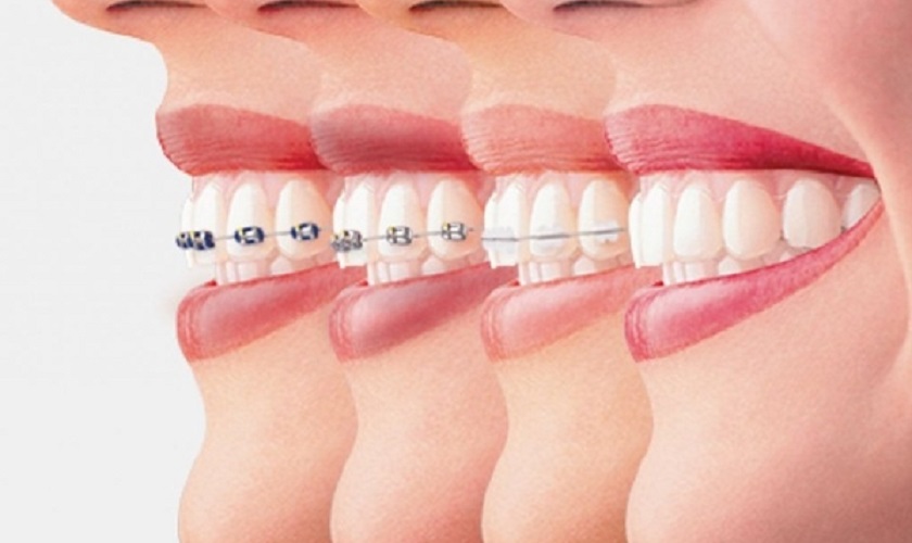 Phương pháp niềng răng được thực hiện
