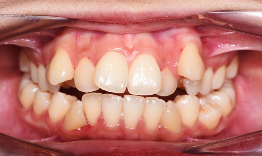 Mức độ sai lệch răng và kế hoạch điều trị của bác sĩ