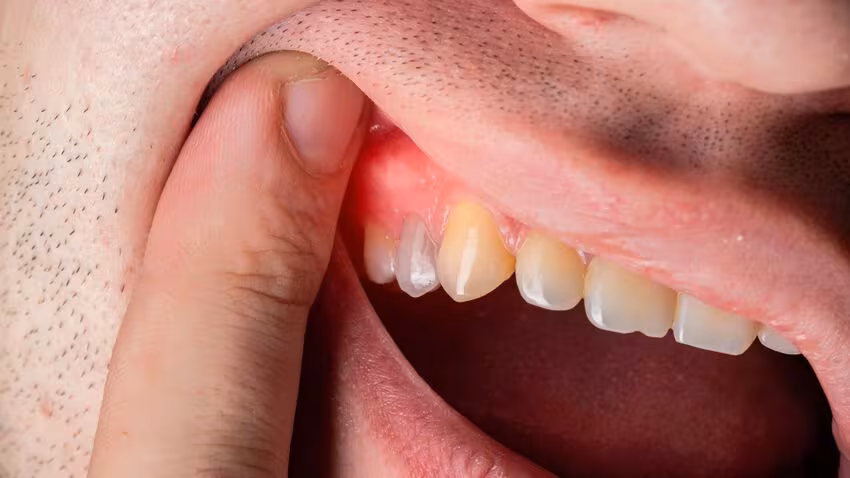Giảm viêm, sưng nướu vùng thực hiện bọc răng sứ hiệu quả