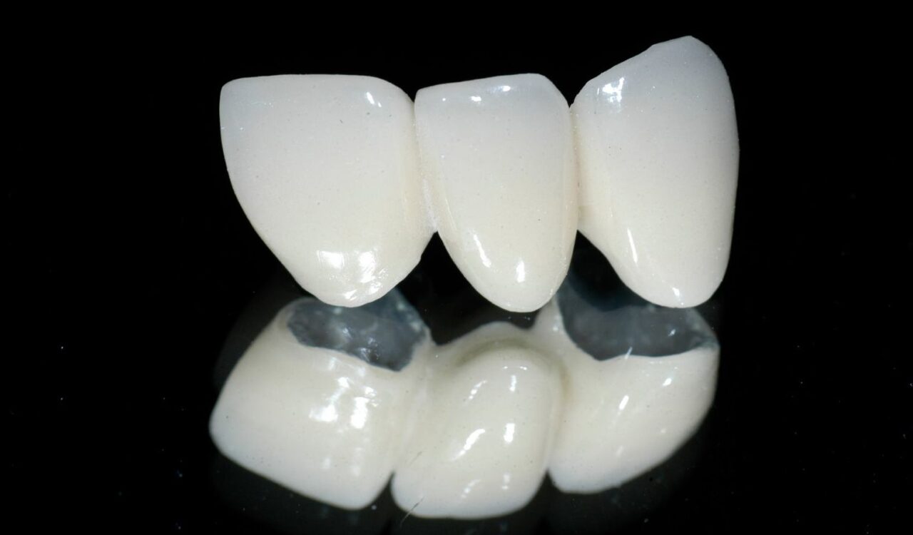 Bọc răng sứ bán phần Titan