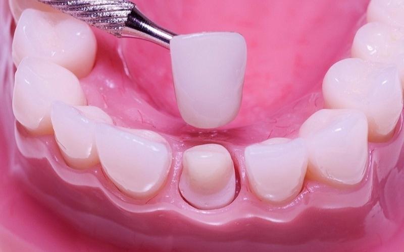 Mão sứ chế tác sai lệch kích thước