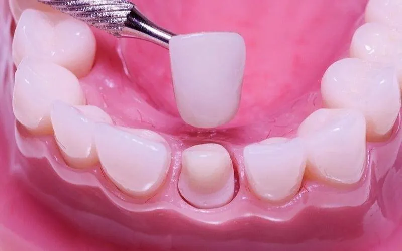 Mão sứ chế tác sai lệch kích thước