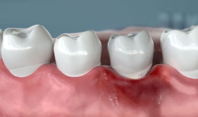 Chất lượng bọc răng sứ không đảm bảo
