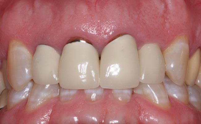 Dấu hiệu răng sứ bị hở gồm những gì?