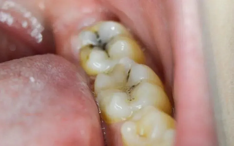 Sâu răng có thể gây ra hiện tượng sưng lợi nổi hạch