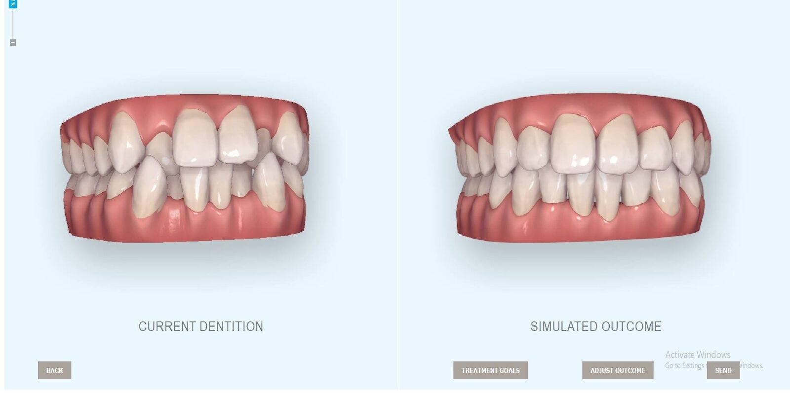Công nghệ mô phỏng niềng răng 3D là gì?