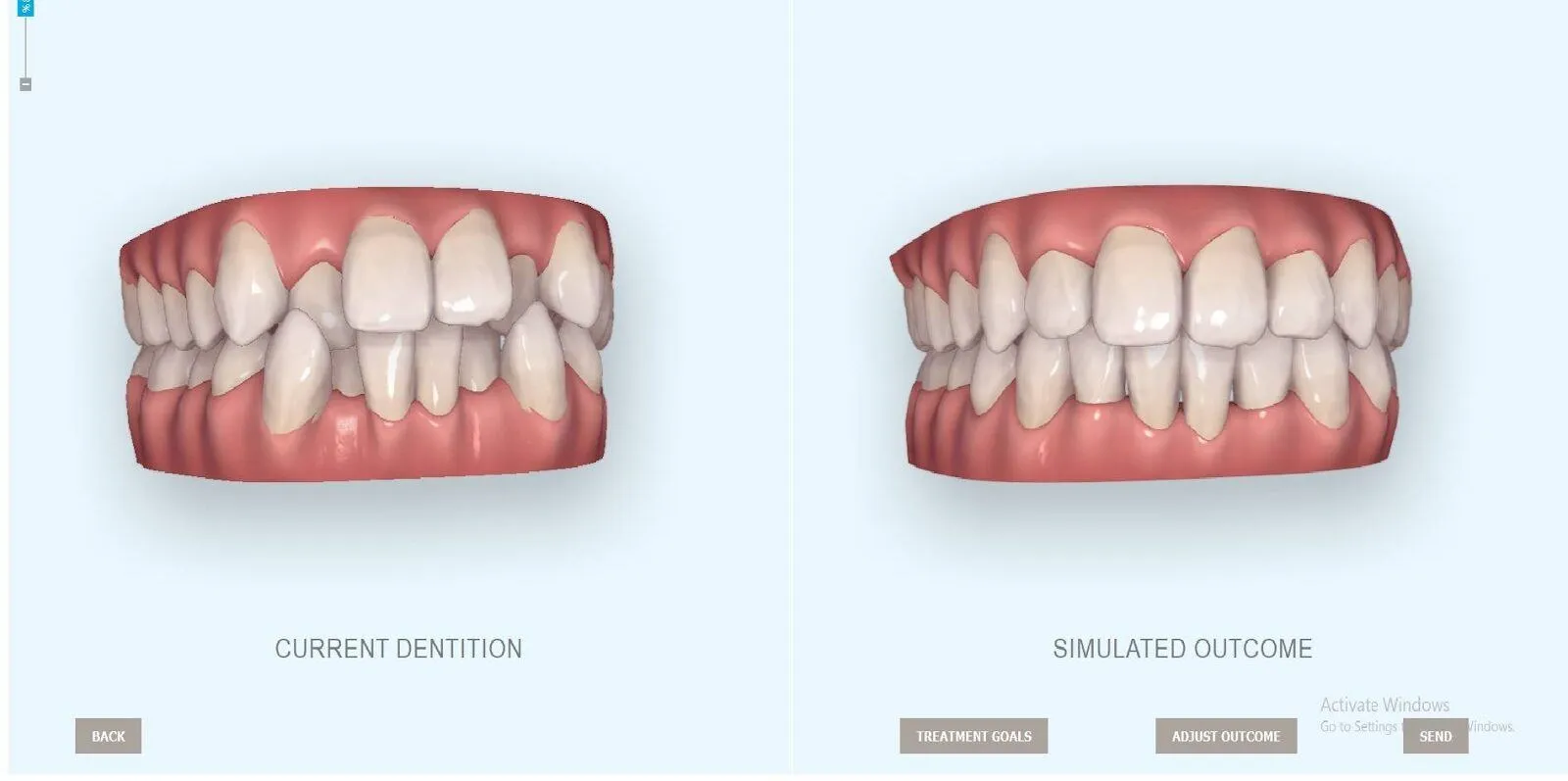 Công nghệ mô phỏng niềng răng 3D là gì?