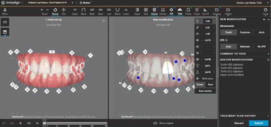 ClinCheck 3D – Giải pháp mô phỏng riêng biệt của Invisalign