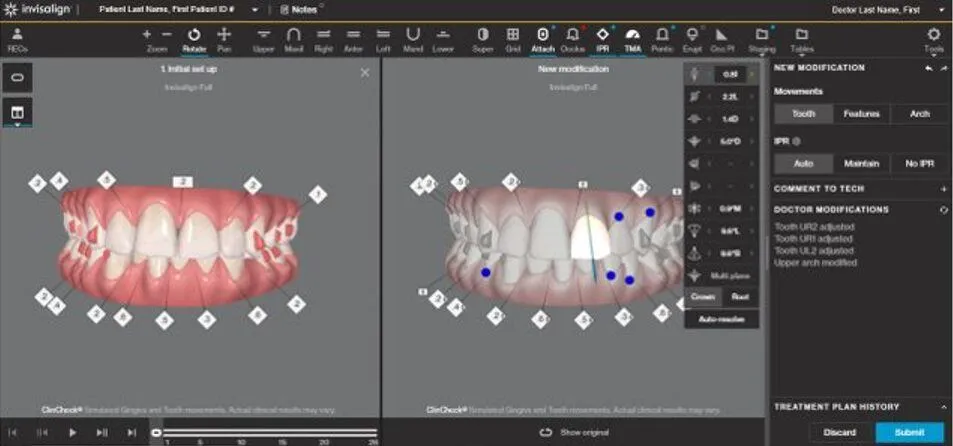 ClinCheck 3D – Giải pháp mô phỏng riêng biệt của Invisalign