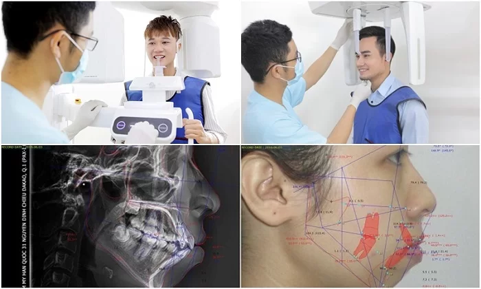 Vceph 3D – Phân tích chỉnh nha toàn diện
